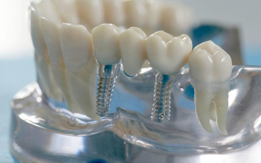 Implantate