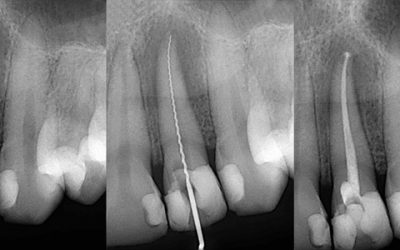 Zähne ret­ten und erhal­ten mit Wurzelfüllungen