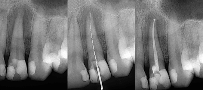 Zähne ret­ten und erhal­ten mit Wurzelfüllungen